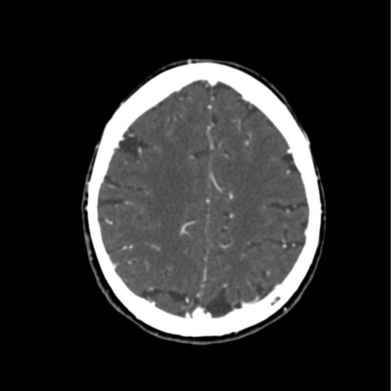 CTA Head Phantom for CT Scan and X-Ray Training