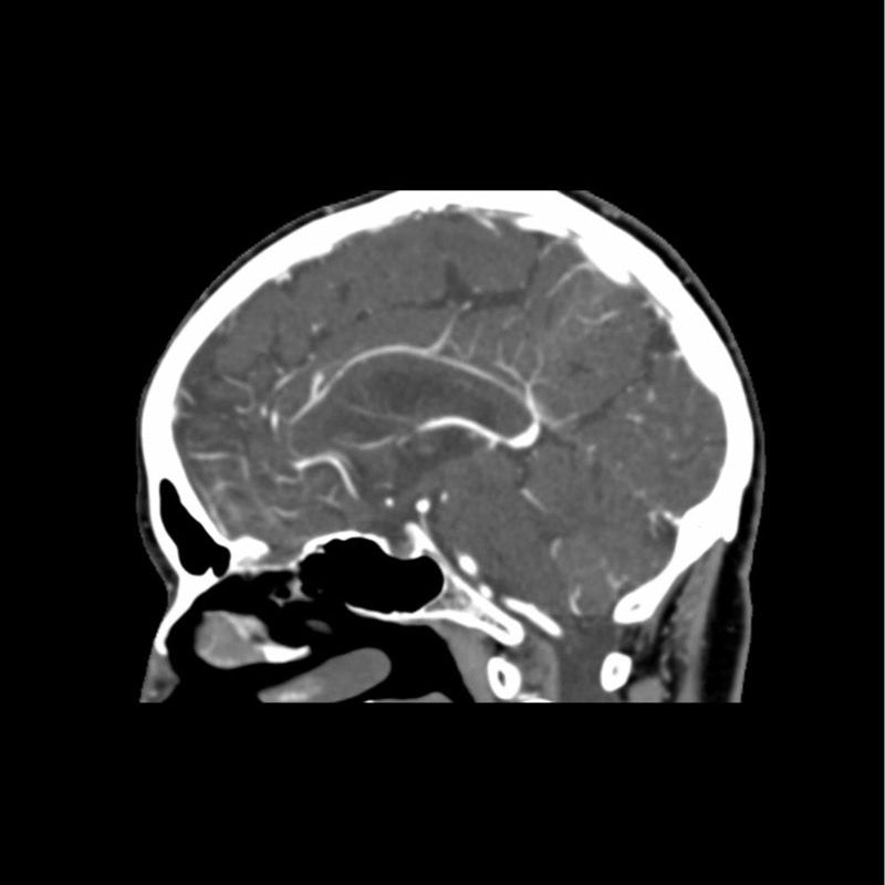 CTA Head Phantom for CT Scan and X-Ray Training