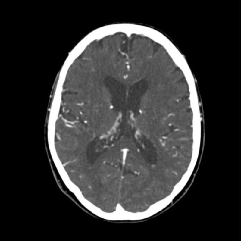 CTA Head Phantom for CT Scan and X-Ray Training
