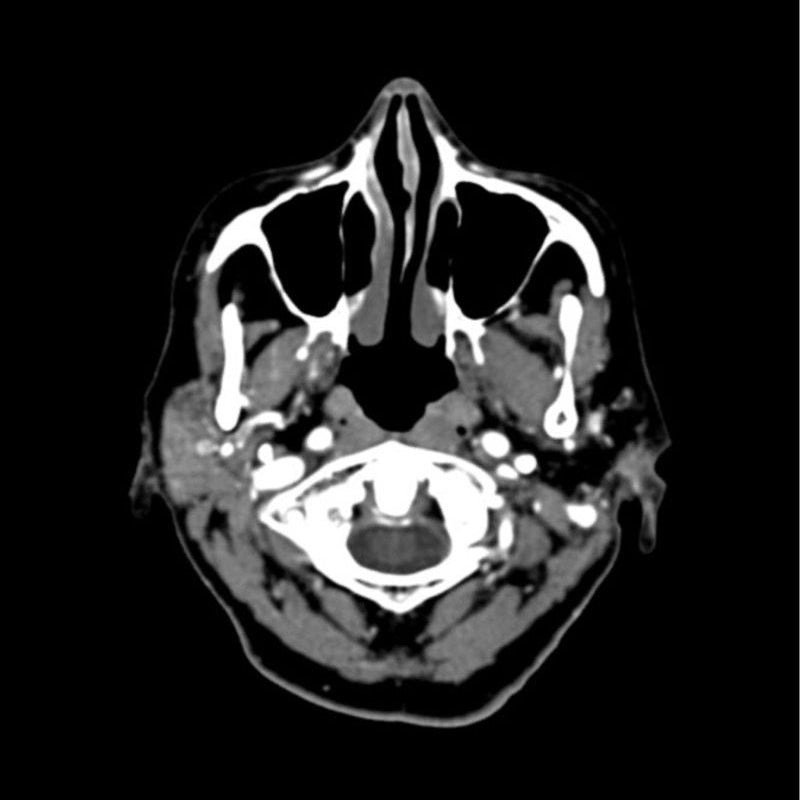 CTA Head Phantom for CT Scan and X-Ray Training