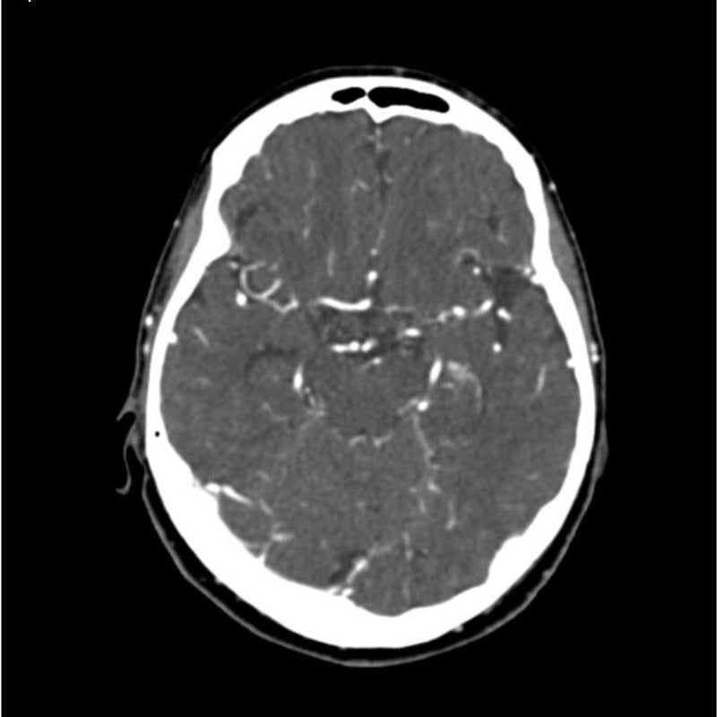 CTA Head Phantom for CT Scan and X-Ray Training