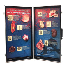 High Blood Pressure Consequences 3-D Display