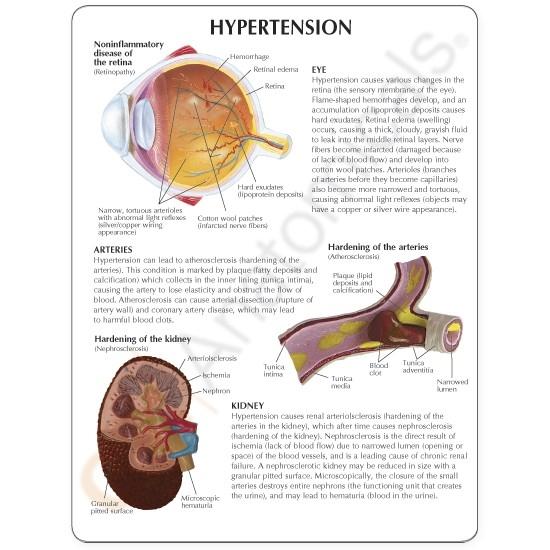 Hypertension Set Model