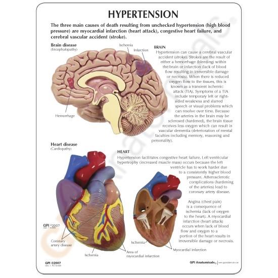 Hypertension Set Model