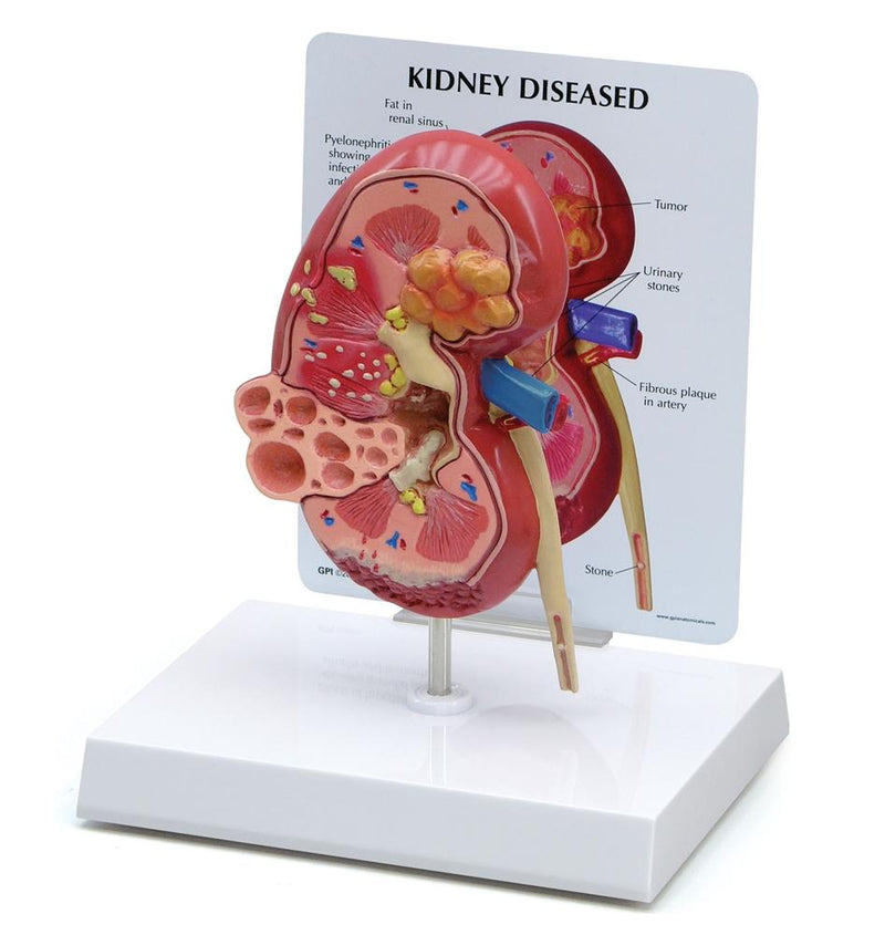 Kidney Model (oversize) with Pathologies
