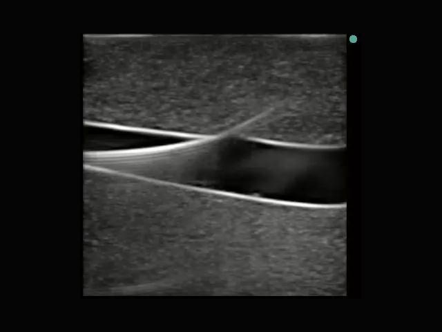 Leg Femoral and Saphenous Vein Venous Access Ultrasound Training Model