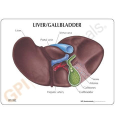 Liver and Gallbladder with Gallstones