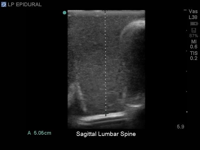 Lumbar Puncture and Spinal Epidural Training Model