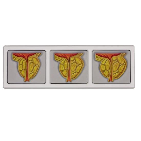 Male Pelvis with 3D Prostate Frame