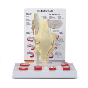 Meniscus Tears Model