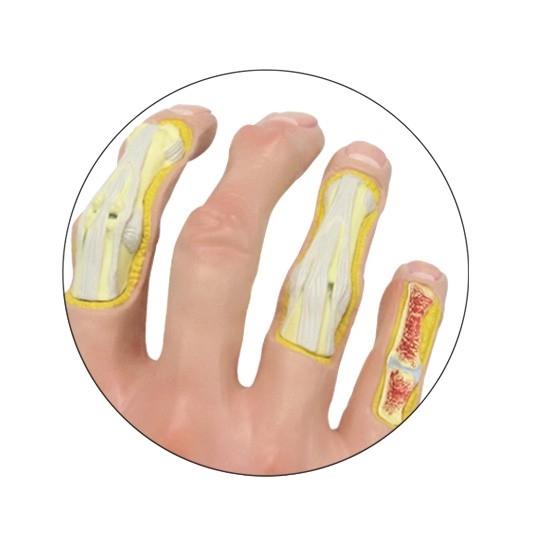 Osteoarthritis (OA) Hand