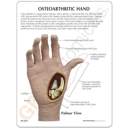 Osteoarthritis (OA) Hand