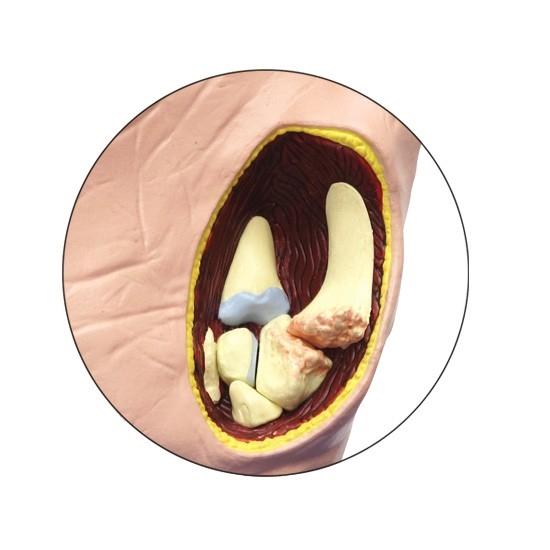 Osteoarthritis (OA) Hand