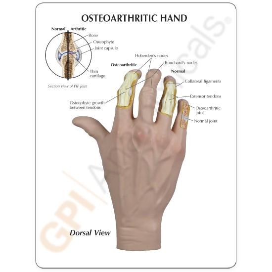 Osteoarthritis (OA) Hand
