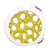 Osteoporosis Model - 4-Piece Hinged Disk Set