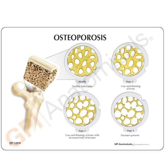 Osteoporosis Model - 4-Piece Hinged Disk Set