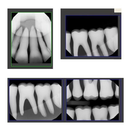 Pediatric X-Ray Dental Model, Articulated