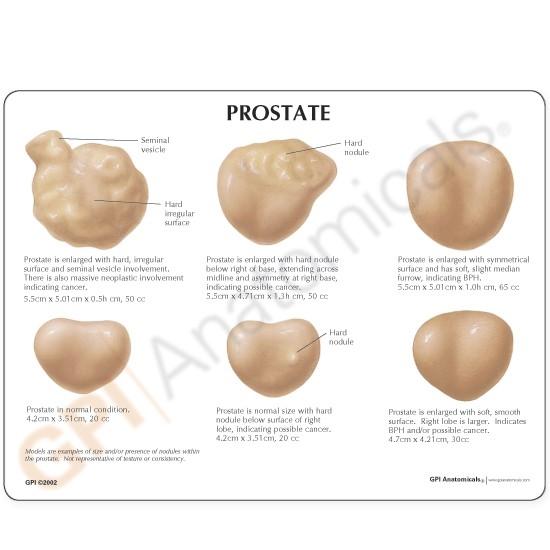 Prostate Model - Enlarged Right Lobe