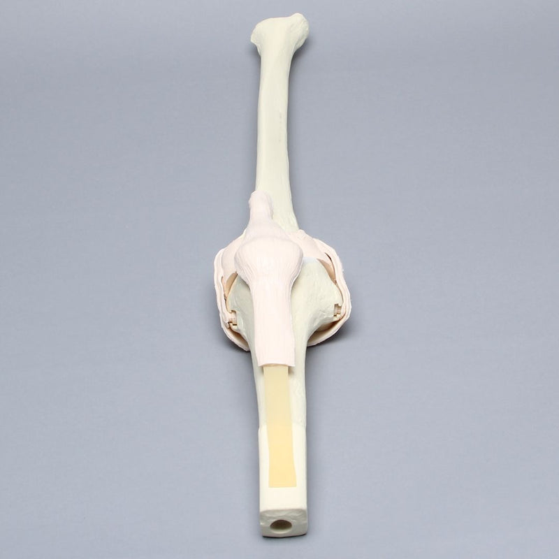Replacement Knee Insert, Arthroscopy