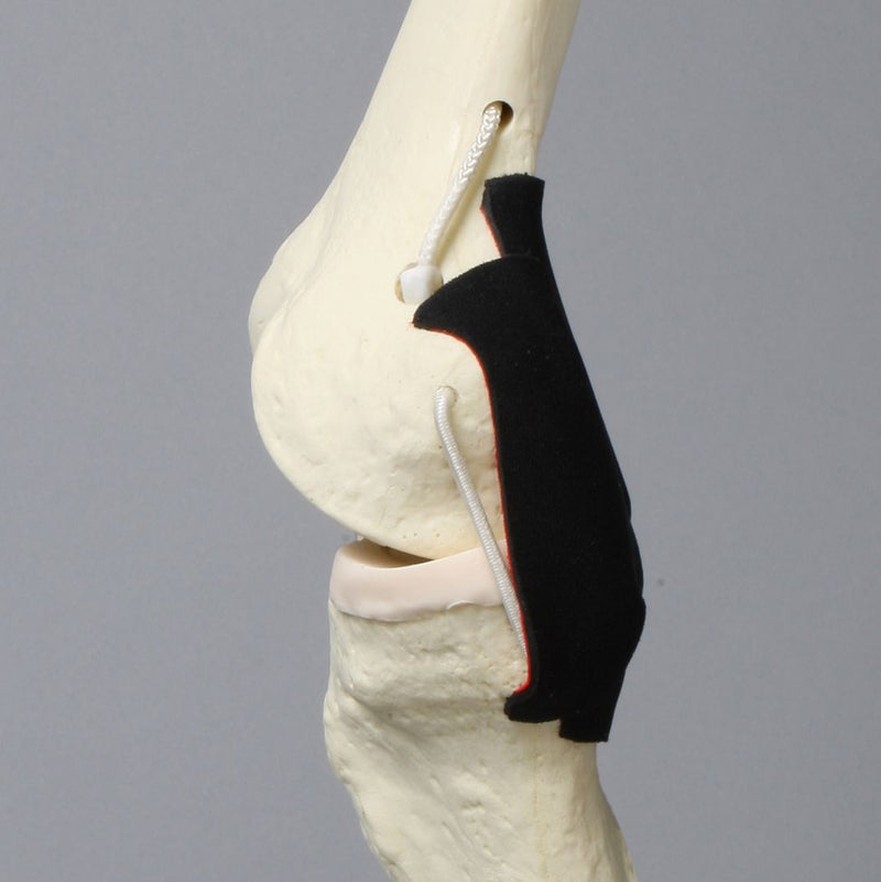 Replacement Knee Insert, Encapsulated ACL with Adjustable Ligament