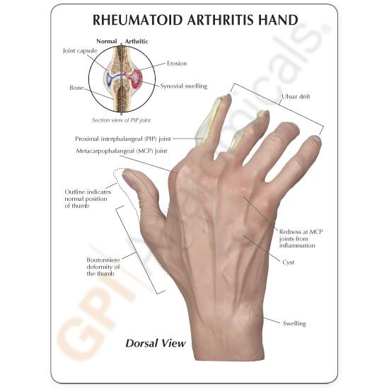 Rheumatoid Arthritis (RA) Hand Model