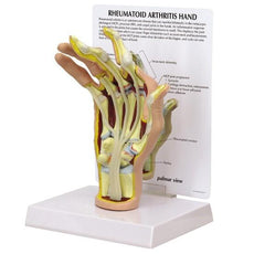 Rheumatoid Arthritis (RA) Hand Model