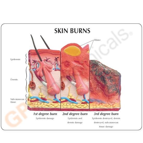 Skin Burn and Normal Skin Model