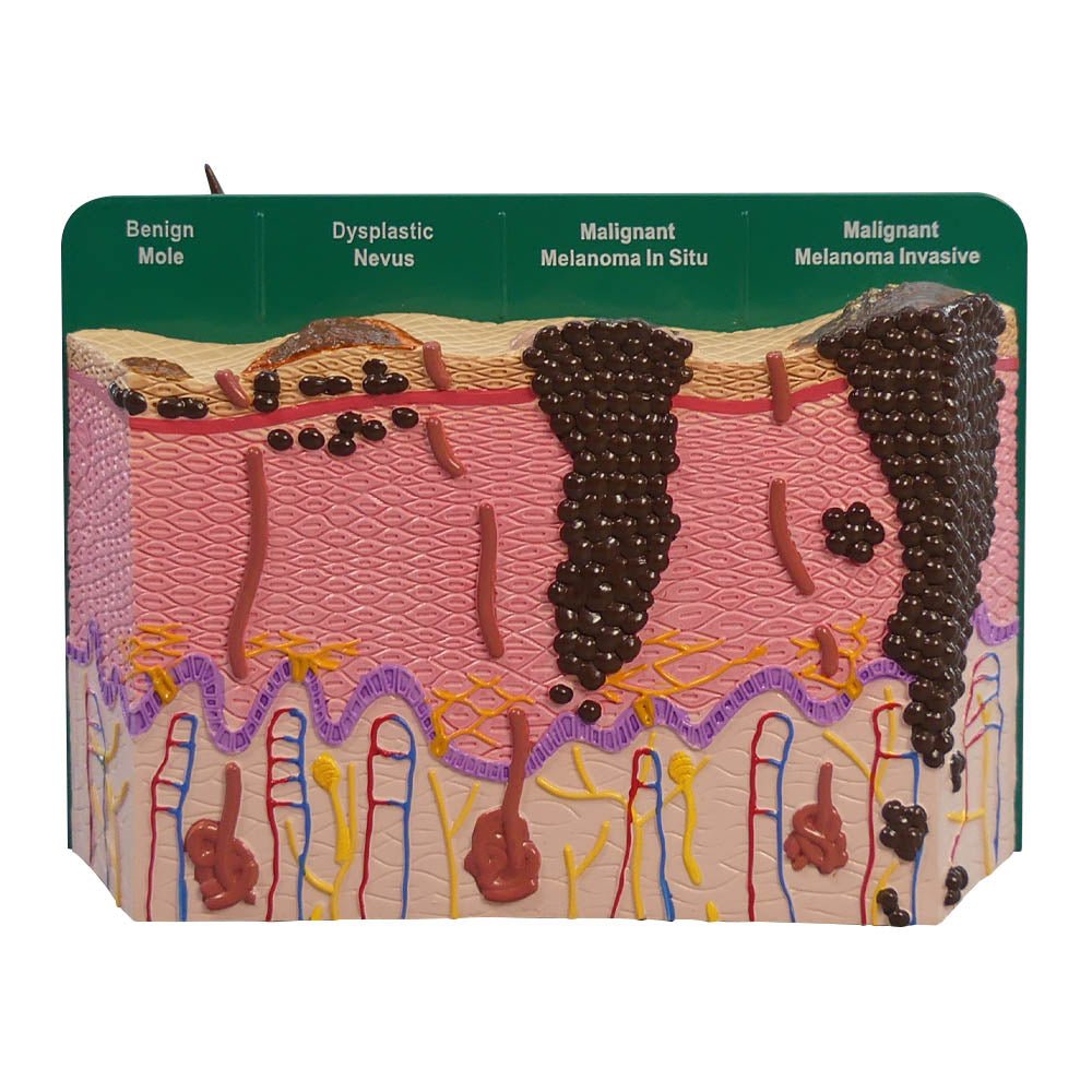 Skin Cancer Model – GTSimulators.com