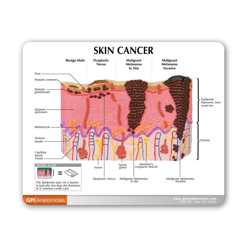 How Skin Cancer Skin Cancer Model – GTSimulators.com