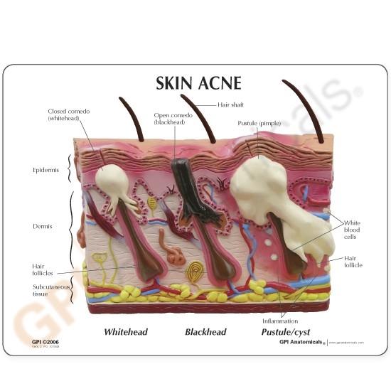 Skin Normal-Acne