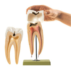 SOMSO Molar Tooth with Caries