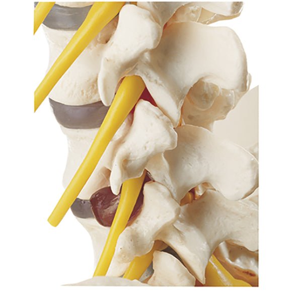 SOMSO Vertebral Column with Pelvis, with prolapsed disc