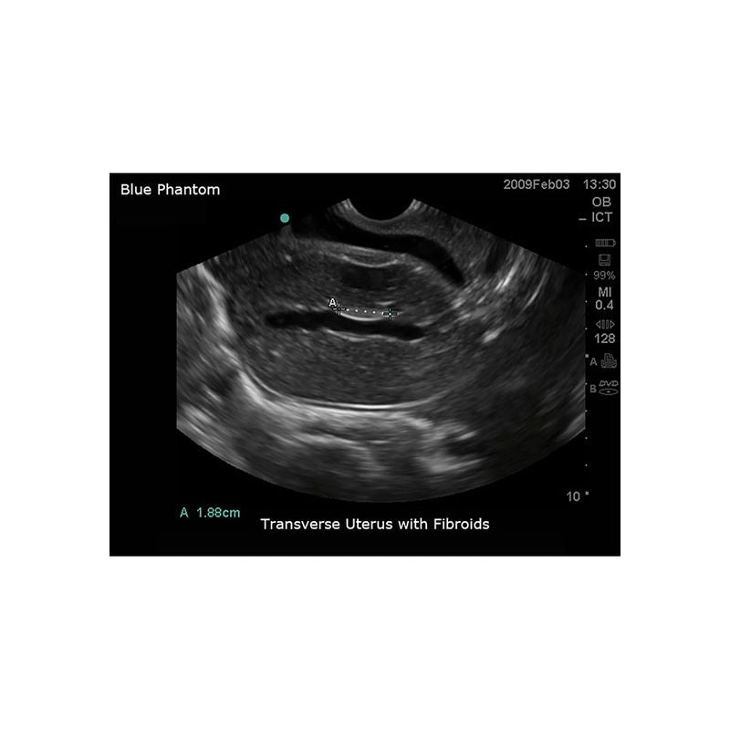 Sonohysterographay & Sonosalpingography Transvaginal Ultrasound Training Model