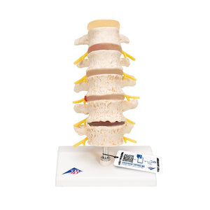 Stages of Disc Prolapse and Vertebral Degeneration Model