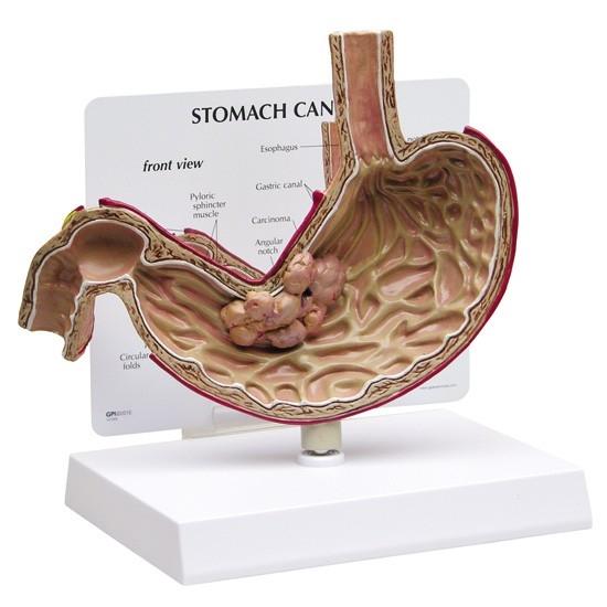 Stomach Model with Cancer