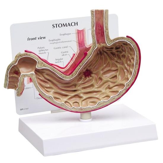 Stomach with Ulcers Model