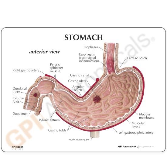 Stomach with Ulcers Model