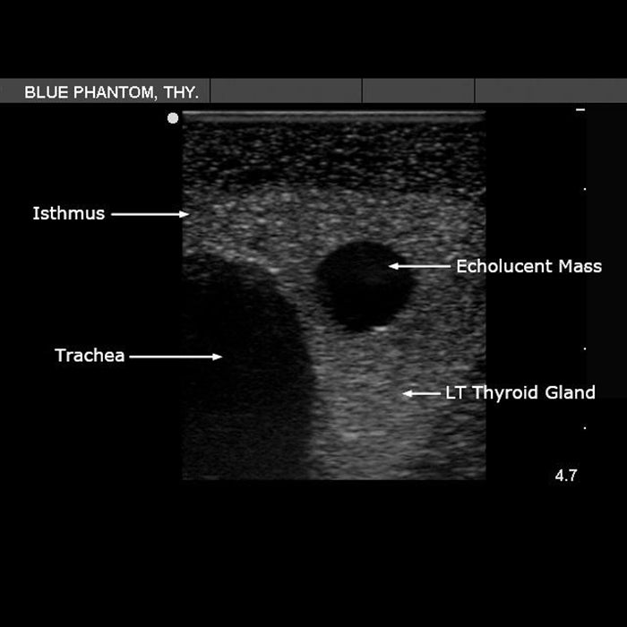 Thyroid Biopsy Ultrasound Training Model