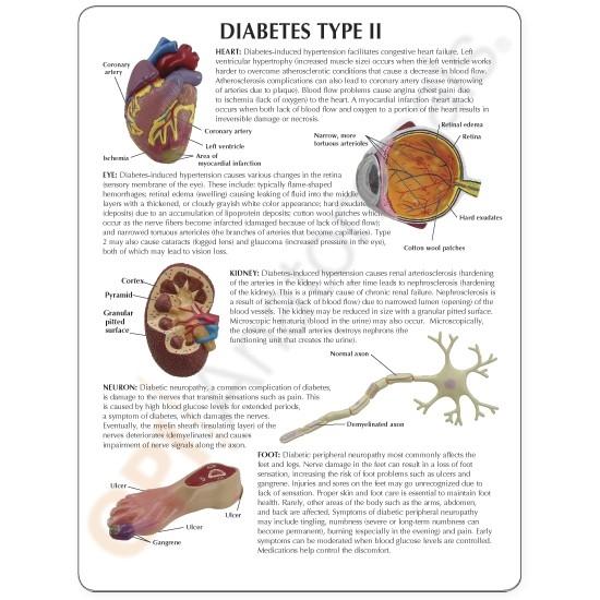 Type II Diabetes Set Model