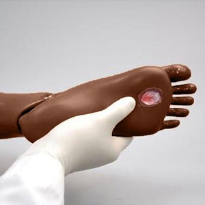 Ulcerated Foot for Simple Susie or Simon, Dark Skin