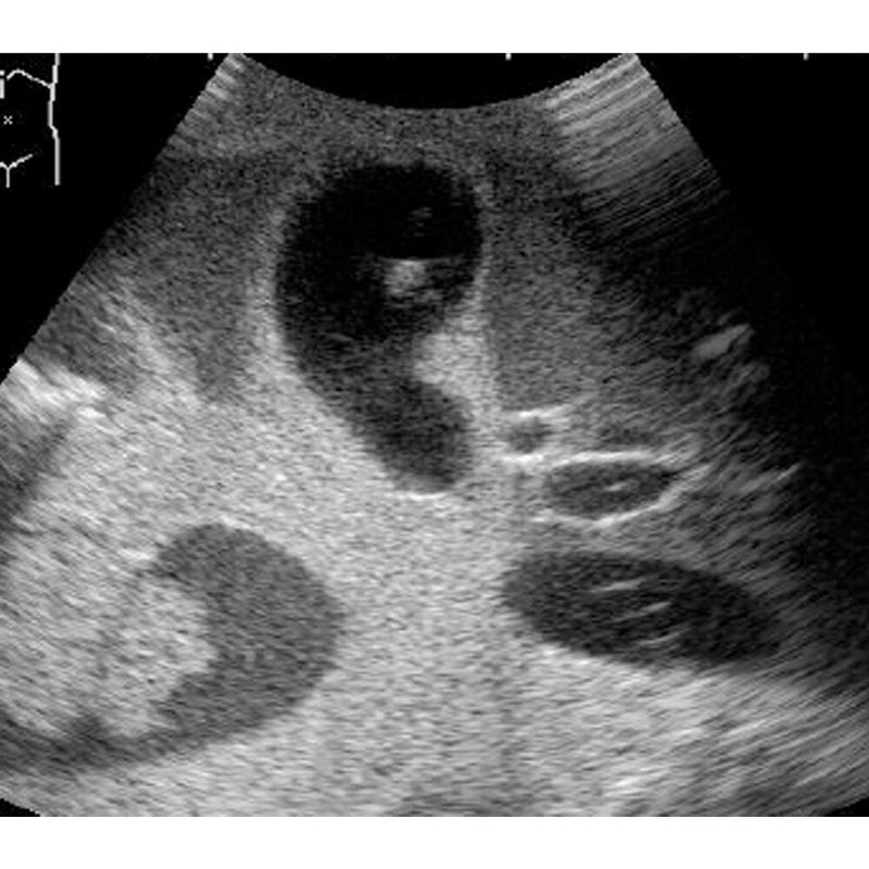 Ultrasound Exam 'ABDFAN' With Pathologies