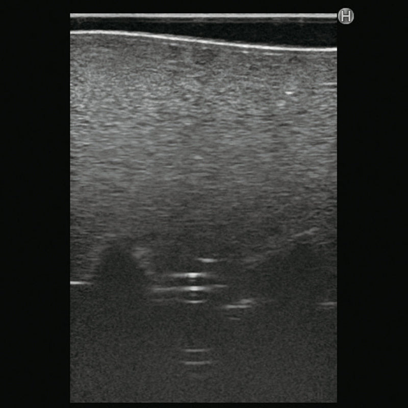Ultrasound Lumbar Puncture Simulator
