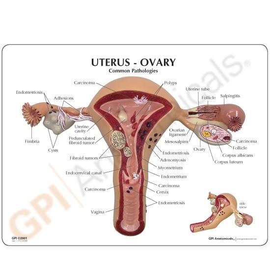 Uterus-Ovary Model with Pathologies