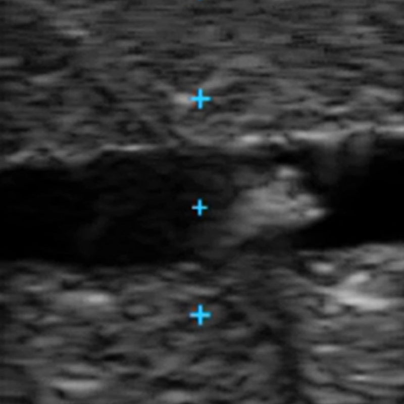 Vascular Access Ultrasound Phantom - 3-Vein Bifurcated