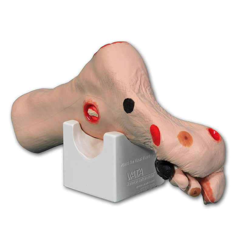'Wilma' Wound Foot Model, Light