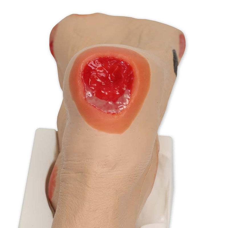 'Wilma' Wound Foot Model, Light