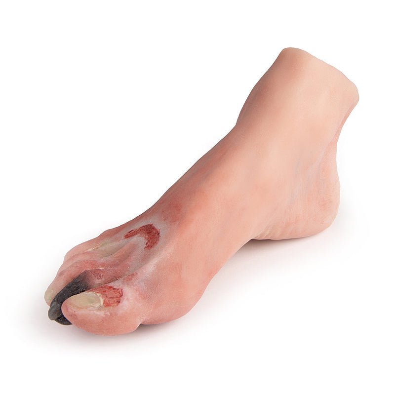 Wound Foot With Diabetic Foot Syndrome