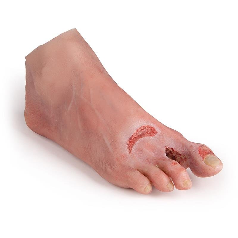 Wound Foot with Diabetic Foot Syndrome, Severe Stage