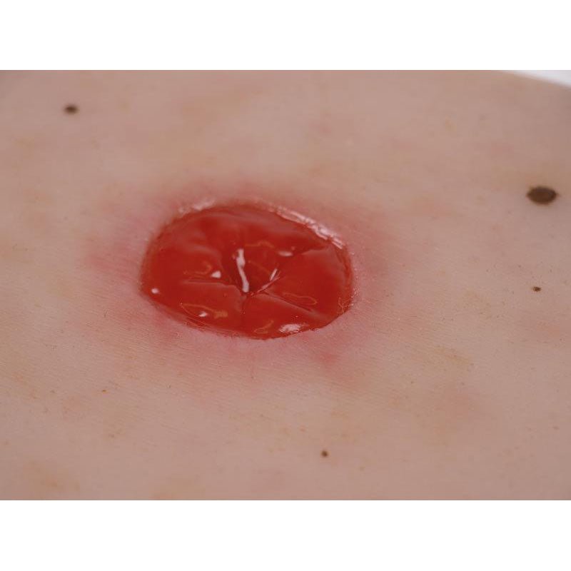 Wound Moulage Colostoma Under Skin Level, Incl. Stand