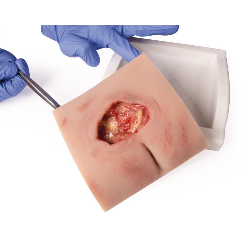 decubitus dressing Wound Moulage Sacral Decubitus, Cleaned Including Stand